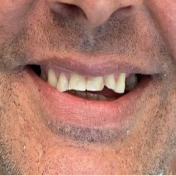 Dental-Teeth-Cleaning