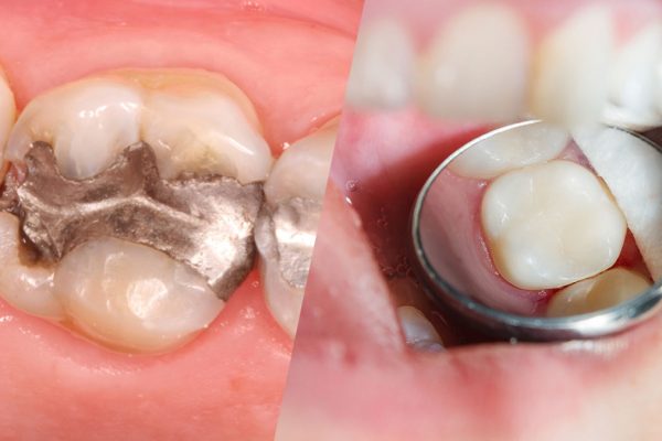 TOOTH COLORED FILLINGS